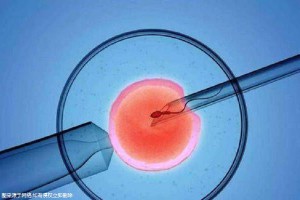 多囊卵巢案例